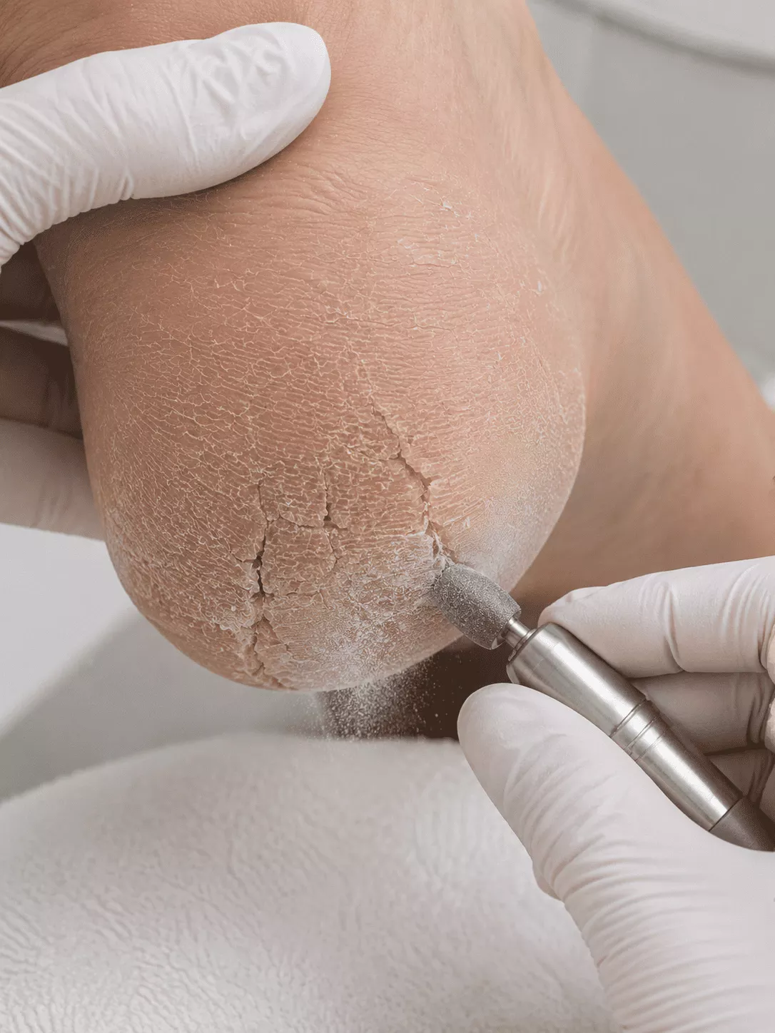 Specialist performing waterless cracked heel care with e-file in Rockville, MD