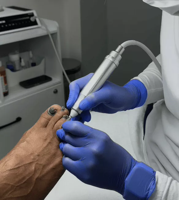 Specialist performing advanced restorative foot care on complex calluses in Rockville, MD