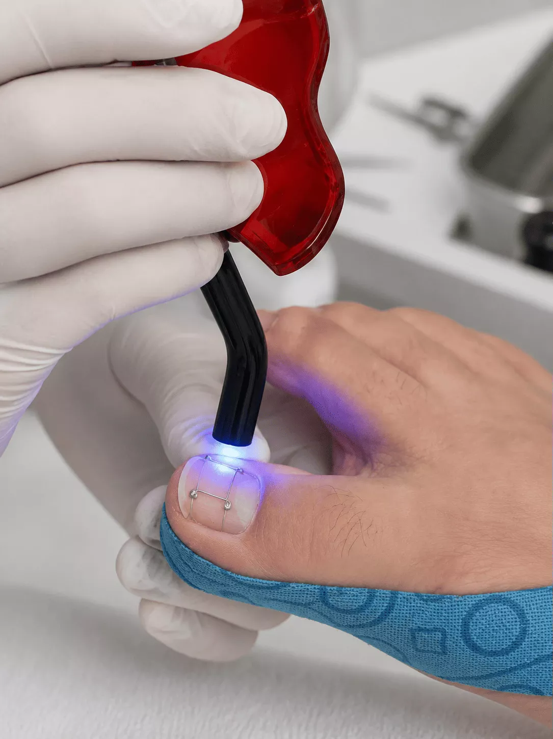 Specialist applying a custom Titanium Thread toenail brace for ingrown nail correction in Rockville, MD