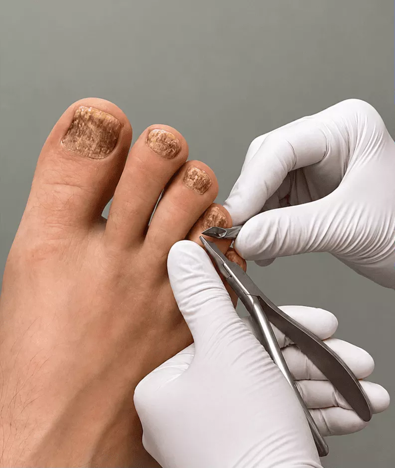 Specialist using painless spray e-file device for toenail fungus care in Rockville, MD